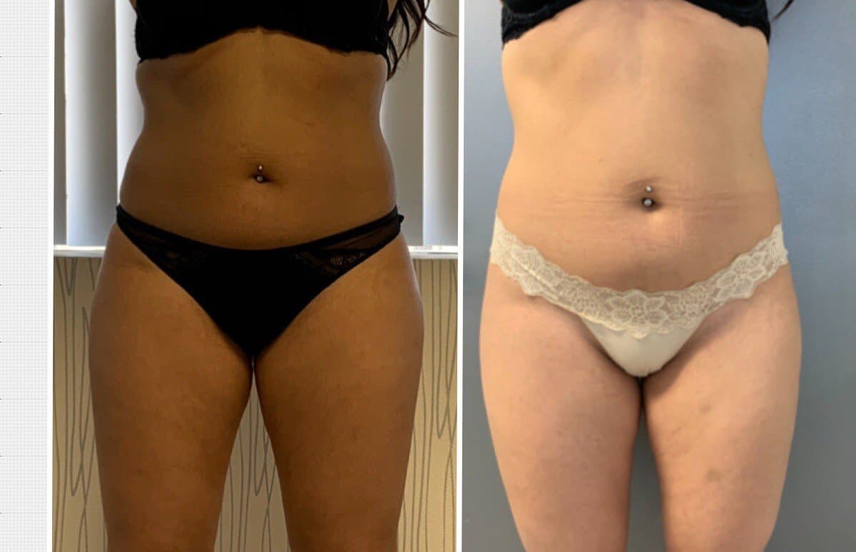 Body Contouring Specialist Near Me in Encino, CA