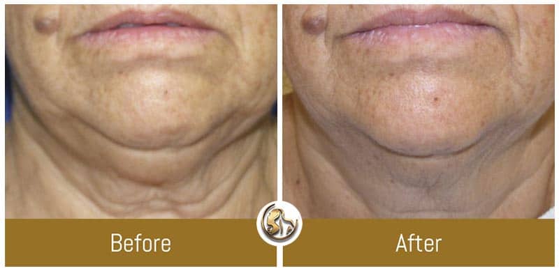 Before and After at Golden Health & Beauty Center in Encino, CA