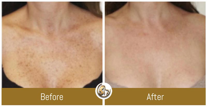 Hyperpigmentation Hyperpigmentation