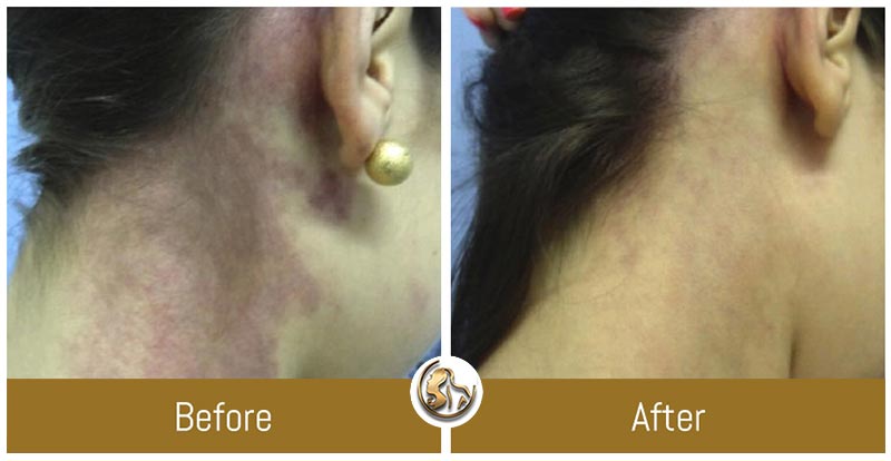 Hyperpigmentation Hyperpigmentation
