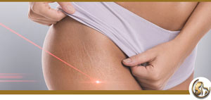 Stretch Marks Removal Procedure Near Me in Encino, CA