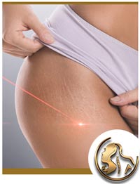 Stretch Marks Removal Near Me in Encino, CA