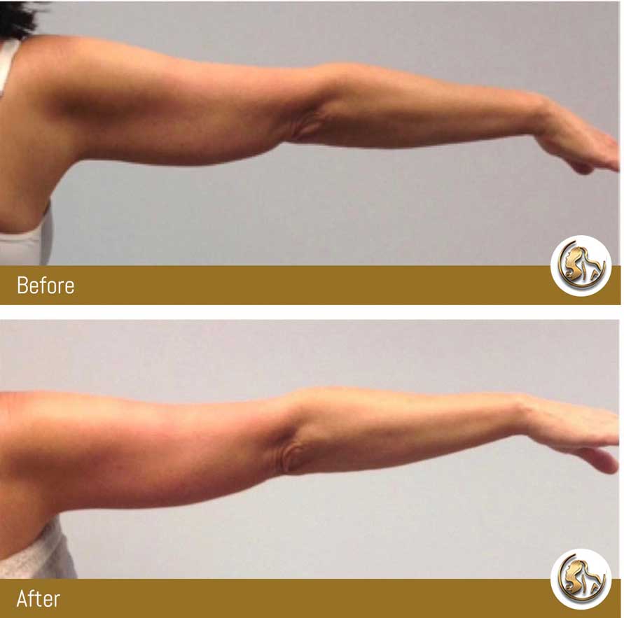 Body Tightening Body Tightening
