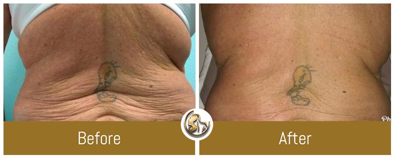 Body Tightening Body Tightening