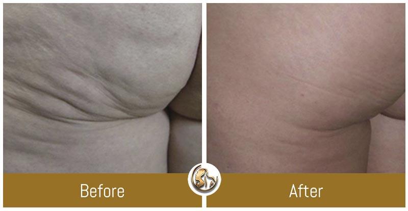 Body Tightening Body Tightening
