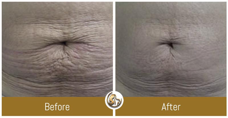 Body Tightening Body Tightening