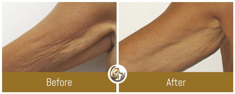 Body Tightening Body Tightening
