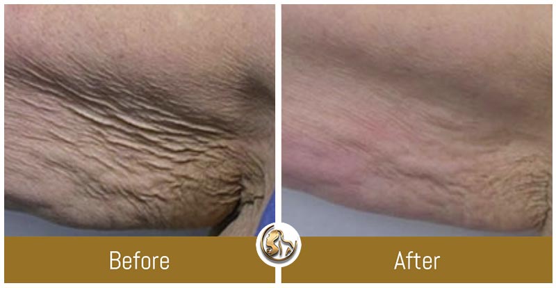 Body Tightening Body Tightening