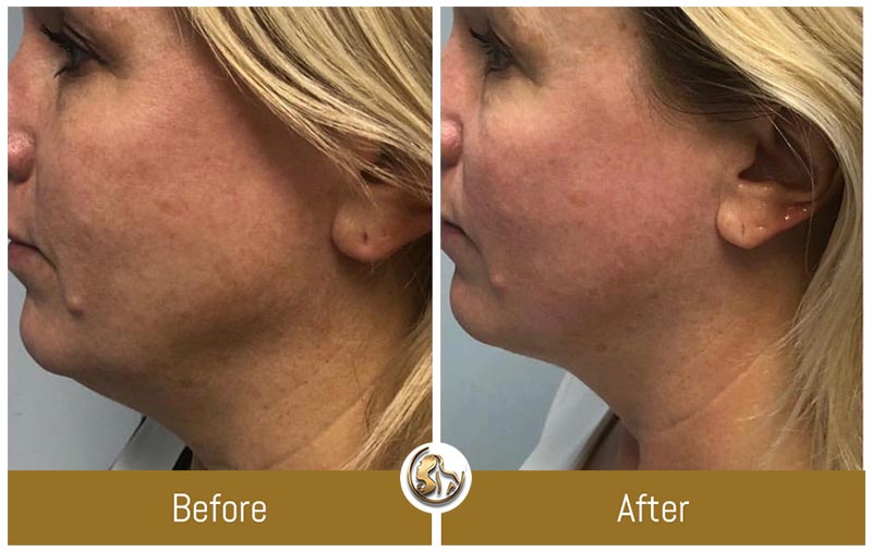 Face and Neck Tightening