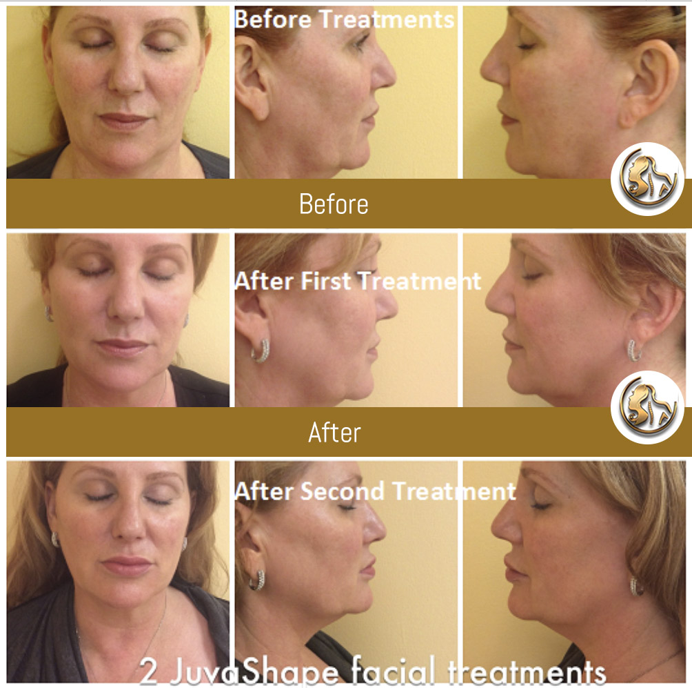 Face and Neck Tightening