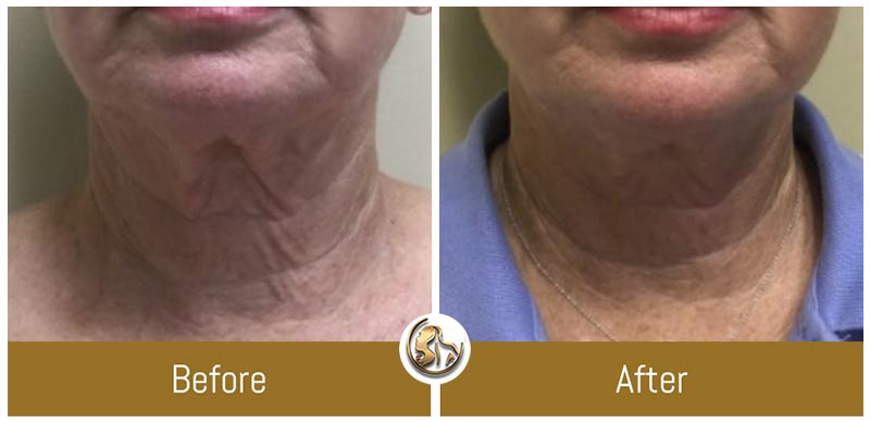 Face and Neck Tightening Face and Neck Tightening
