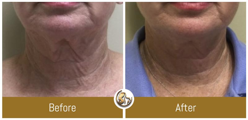 Face and Neck Tightening