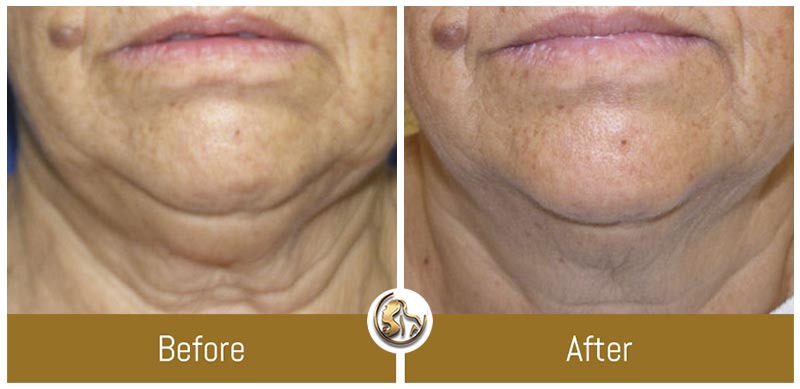 Face and Neck Tightening