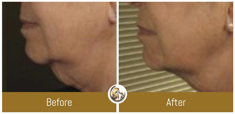 Face and Neck Tightening