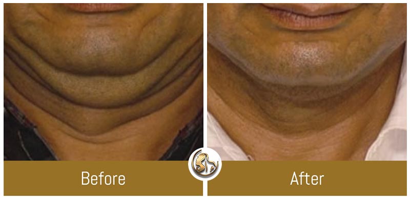 Face and Neck Tightening