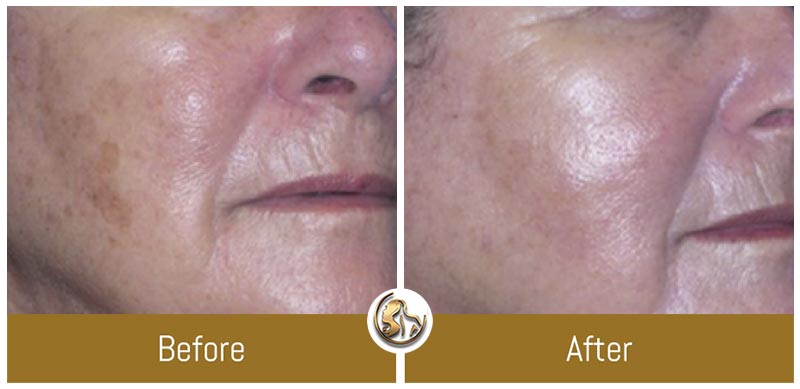 Face and Neck Tightening Face and Neck Tightening