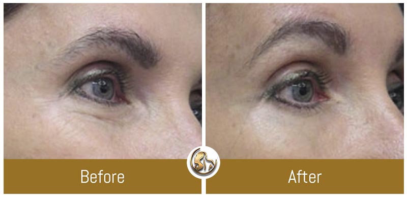 Face and Neck Tightening Face and Neck Tightening