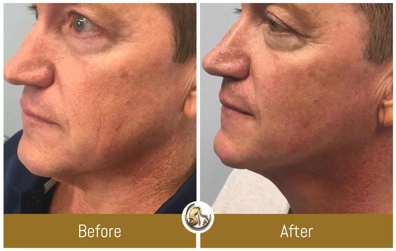 Face and Neck Tightening