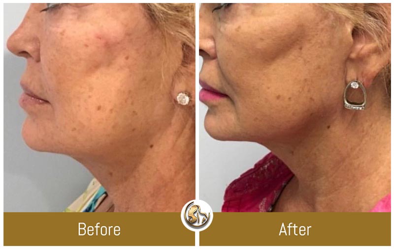 Face and Neck Tightening