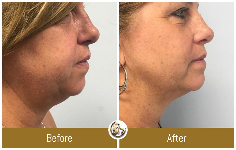 Face and Neck Tightening