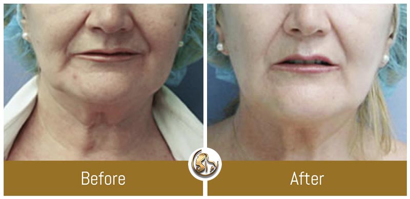 Face and Neck Tightening