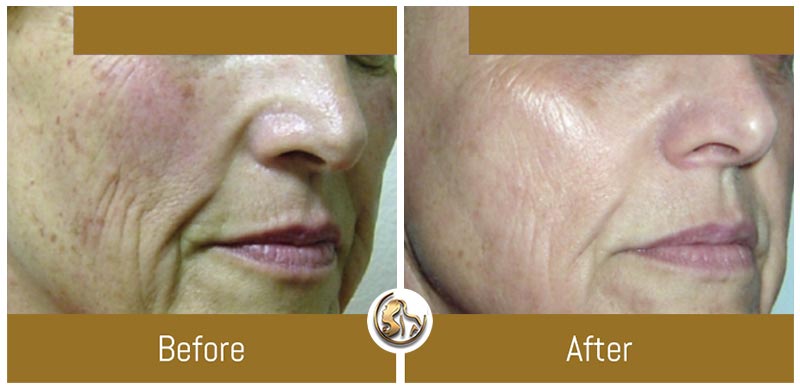 Face and Neck Tightening Face and Neck Tightening
