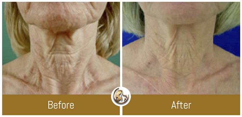 Face and Neck Tightening