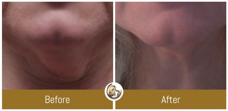 Face and Neck Tightening