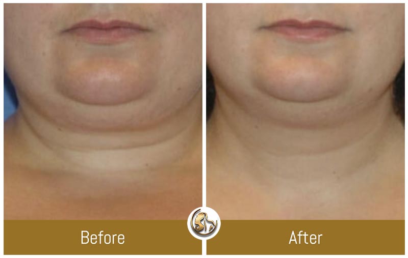 Face and Neck Tightening Face and Neck Tightening