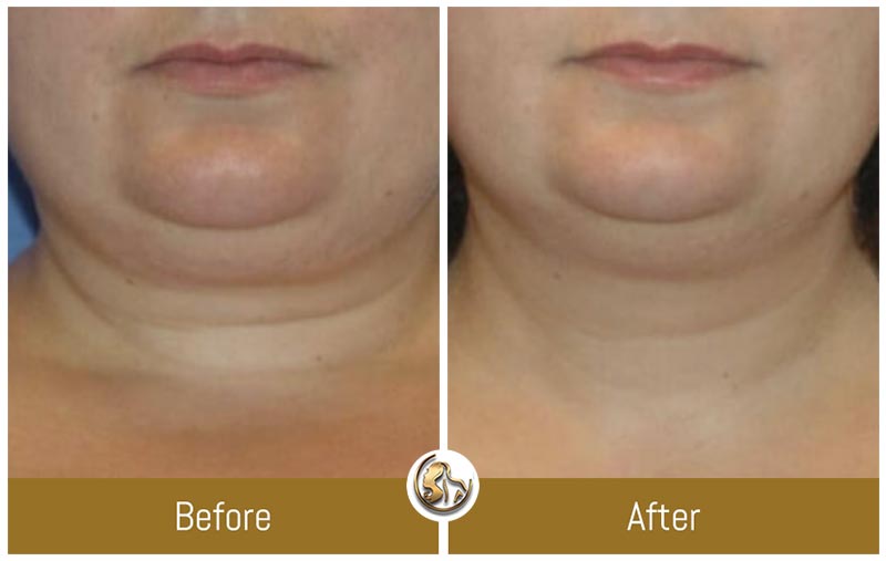 Face and Neck Tightening