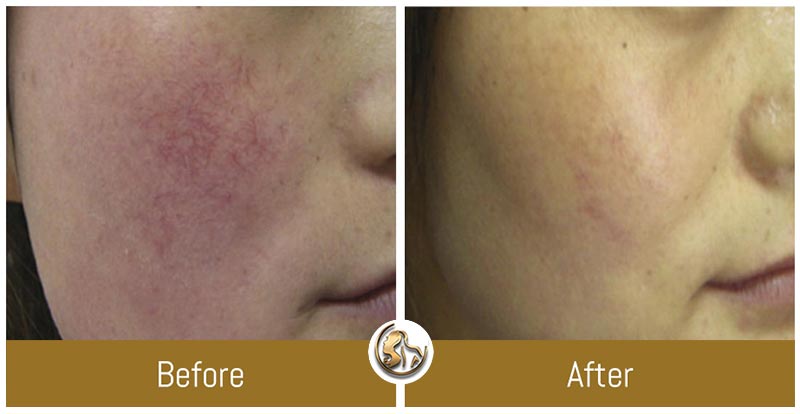Hyperpigmentation Hyperpigmentation