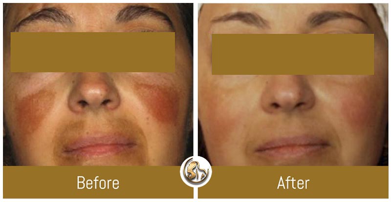 Hyperpigmentation Hyperpigmentation