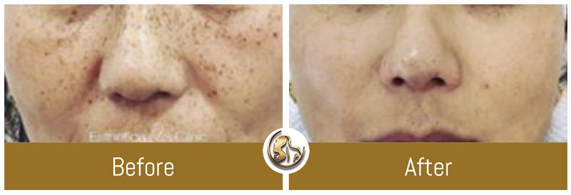 Hyperpigmentation