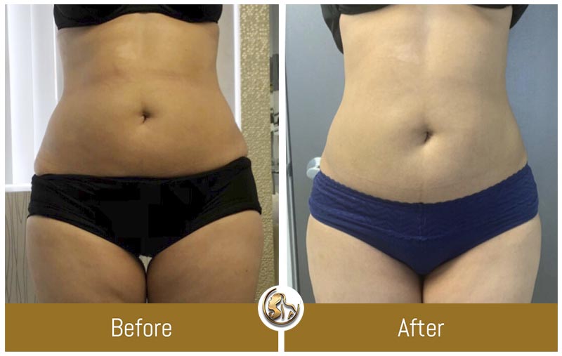UltraSlim UltraSlim