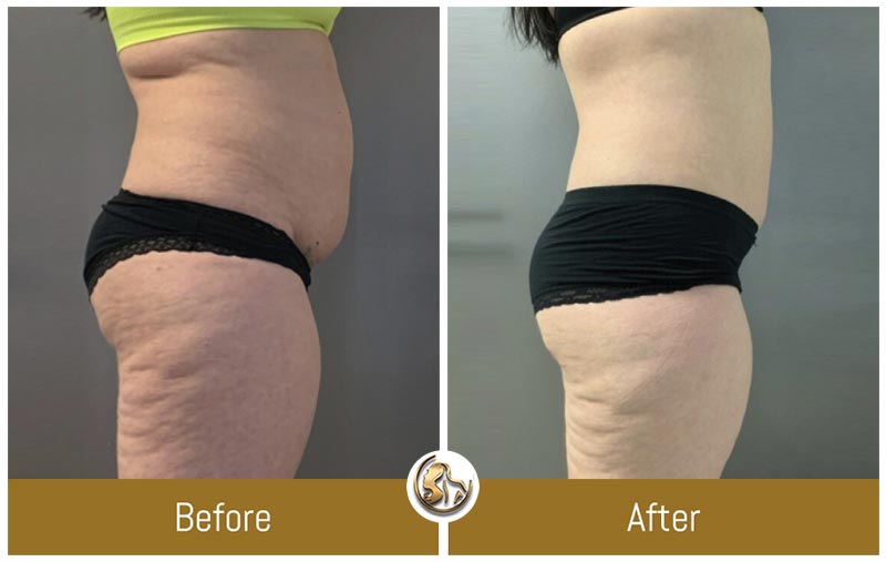 UltraSlim UltraSlim