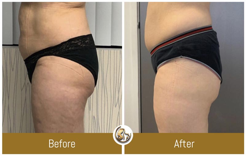 UltraSlim UltraSlim