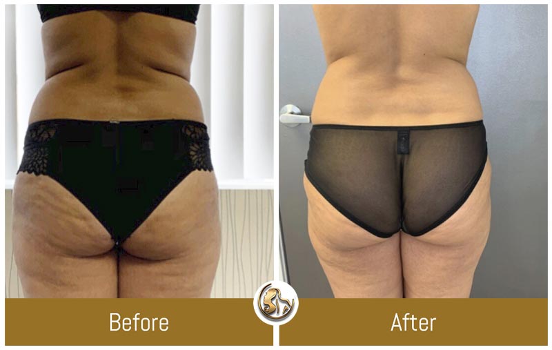 UltraSlim UltraSlim