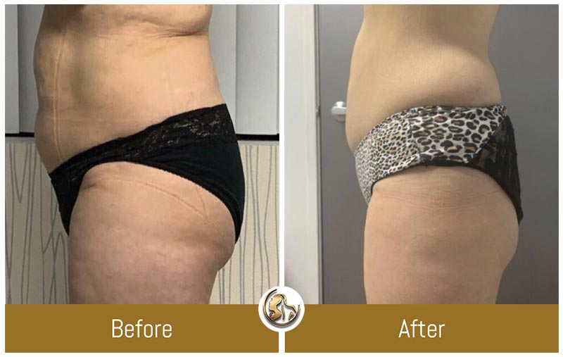UltraSlim UltraSlim