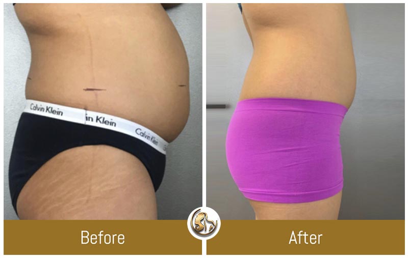 UltraSlim UltraSlim