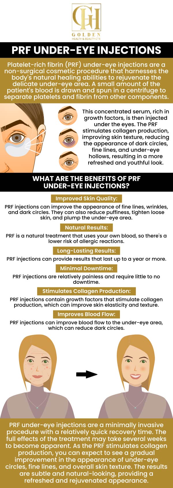 Under-eye fillers are an aesthetic procedure that treats hollows under the eyes and dark circles. The benefits include quick outcomes, minimum downtime, and a more youthful appearance. Under-eye fillers will help combat the signs of aging. If you need under eye fillers, consult Dr. Pantea Nikaeen, DC at Golden Health and Beauty Center. Contact us today to learn more or schedule your appointment online. We are located at 16661 Ventura Blvd Ste 700 Encino, CA 91436. Under-eye fillers are an aesthetic procedure that treats hollows under the eyes and dark circles. The benefits include quick outcomes, minimum downtime, and a more youthful appearance. Under-eye fillers will help combat the signs of aging. If you need under eye fillers, consult Dr. Pantea Nikaeen, DC at Golden Health and Beauty Center. Contact us today to learn more or schedule your appointment online. We are located at 16661 Ventura Blvd Ste 700 Encino, CA 91436.