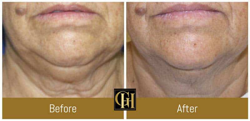 Before and After at Golden Health & Beauty Center in Encino, CA